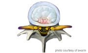 spinal stenosis