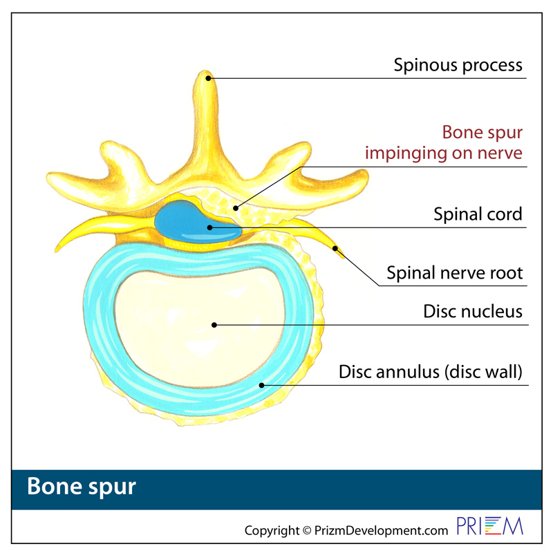 bone spur