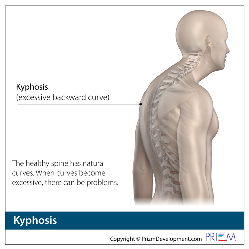 Kyphosis  Spine Group Orlando