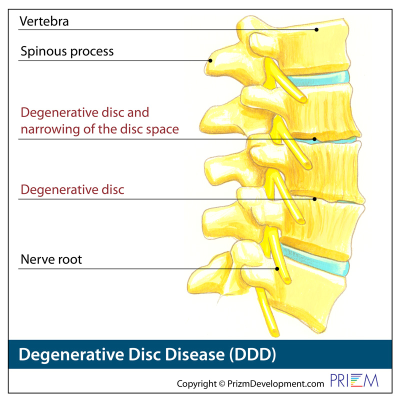 degenerative disc disease treatment