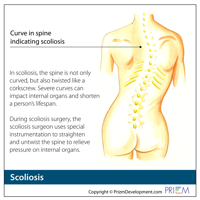 Scoliosis Overview  Spine Group Orlando