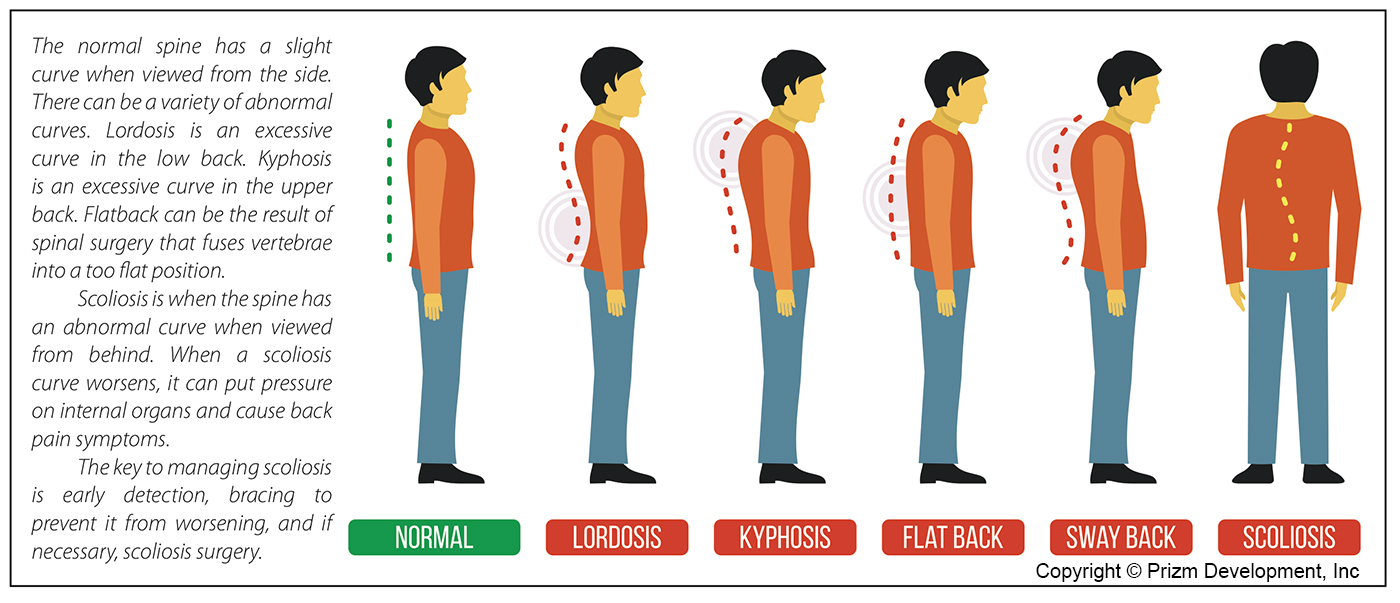 Flatback Syndrome  Spine Group Orlando